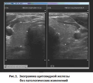 Эхограмма щитовидной железы без патологических изменений 11 (4) 300 268