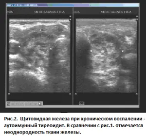 Щитовидная железа при хроническом воспалении аутоиммунный тиреоидит. В сравнении с рис.1. отмечается неоднородность ткани железы 22 (6) 300 279