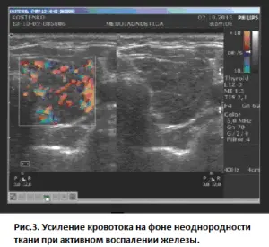 Усиление кровотока на фоне неоднородности ткани при активном воспалении железы 33 (3) 300 275