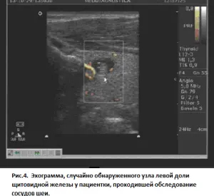 Эктограмма, случайно обнаруженного узла левой доли щитовидной железы у пациента, проходившей обследование сосудов шеи 44 (2) 300 275