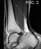 Ахиллова сухожилия на МРТ Ахиллова сухожилия на МРТ