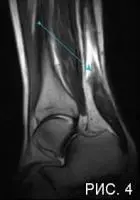 Разрыв ахиллова сухожилия Разрыв ахиллова сухожилия