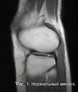 Нормальный мениск Нормальный мениск