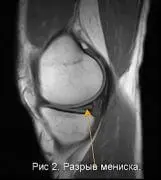 Поврежденный мениск Поврежденный мениск