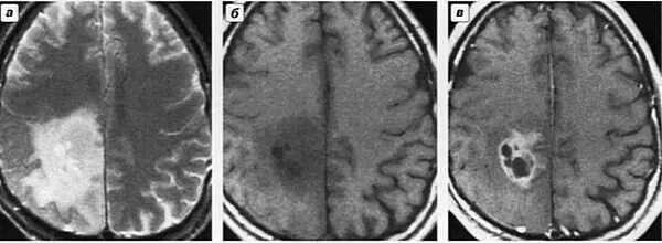 Опухоль головного мозга. 1 (1)