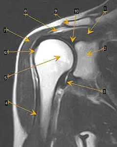 МРТ для определения патологии плечевого сустава МРТ для определения патологии плечевого сустава