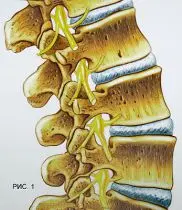Всегда ли причиной боли в спине бывает грыжа межпозвонкового диска?