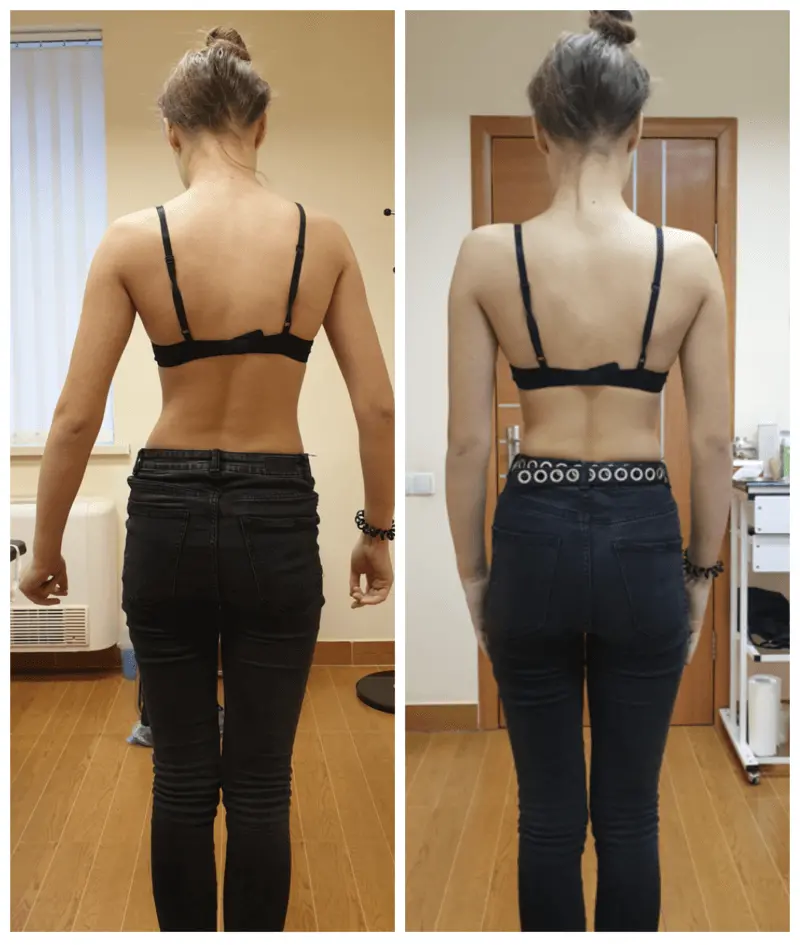 Сколиоз. Причины развития сколиоза