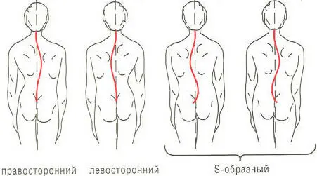 Виды сколиоза Виды сколиоза у детей