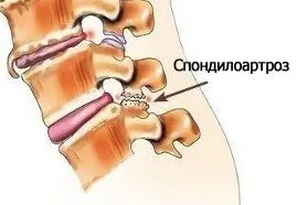причини болі в поясниці
