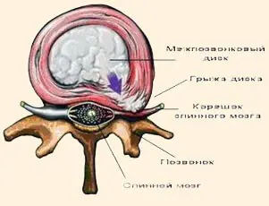 Що таке грижа диска: етапи формування міжхребцевої грижі та її лікування