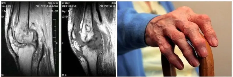 ревматоїдний артрит