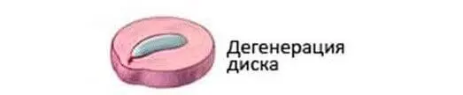 Що таке грижа диска: етапи формування міжхребцевої грижі та її лікування
