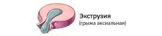 Що таке грижа диска: етапи формування міжхребцевої грижі та її лікування
