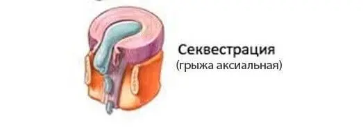 Що таке грижа диска: етапи формування міжхребцевої грижі та її лікування