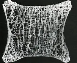 Остеопороз: симптомы, причины развития, диагностика и лечение в Киеве