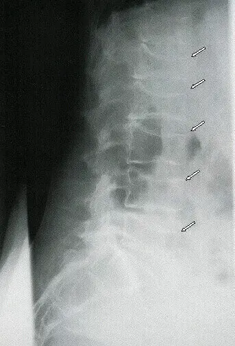 Остеопороз: симптомы, причины развития, диагностика и лечение в Киеве