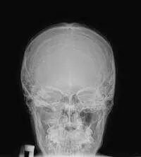 рентгенографія черепа рентгенографія черепа голови