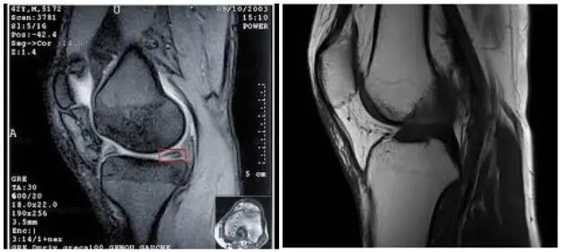 Біль в коліні. Лікування болю в коліні в Києві