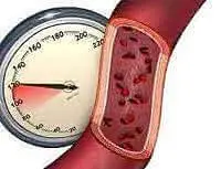 Артериальная гипертензия Артериальная гипертензия