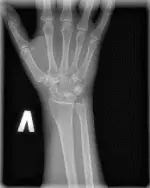 Цифровой рентген лучезапястного сустава Цифровой рентген лучезапястного сустава