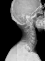 Рентген шийного відділу хребця Рентген шийного відділу хребця