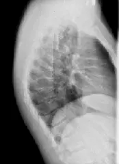 Рентген грудного відділу хребта цифровий рентген грудного відділу хребта