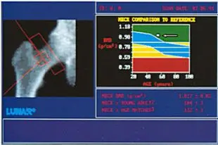 Диагностика остеопороза тазобедренного сустава Диагностика остеопороза тазобедренного сустава
