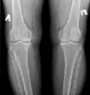 Цифровий рентген колінного суглоба Цифровий рентген колінного суглоба