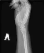 Рентгенография лучезапястного сустава Рентгенография лучезапястного сустава