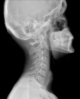 Рентген шийного відділу хребця Рентген шийного відділу хребця