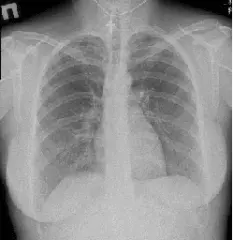 Рентген грудного відділу хребта Рентген грудного відділу