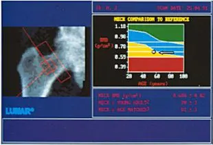 Диагностика остеопороза костей тазобедренного сустава Диагностика остеопороза костей тазобедренного сустава