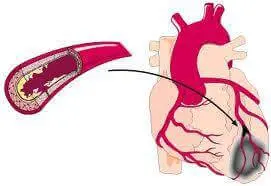 Ишемическая болезнь сердца Ишемическая болезнь сердца