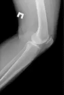 Цифровий рентген колінного суглоба рентген коліна