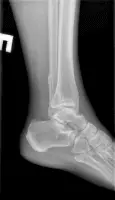 Рентген голеностопного сустава Рентген голеностопного сустава