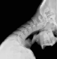 Рентген шийного відділу хребця Рентген шийного відділу хребта