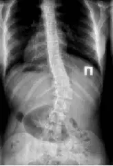 Рентген грудного відділу хребта Рентген грудного відділу хребта