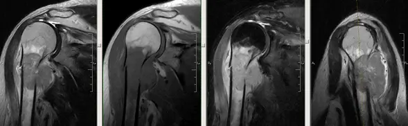 Освіта проксимального відділу діафіза правої плечової кістки, з проростанням в прилеглі м'які тканини плеча Освіта проксимального відділу діафіза правої плечової кістки, з проростанням в прилеглі м'які тканини плеча