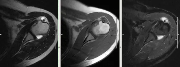 Тендосиновіт сухожилля довгої головки біцепса плеча МРТ плечового суглоба