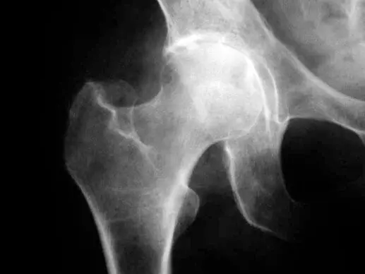 Артроз тазобедренного сустава