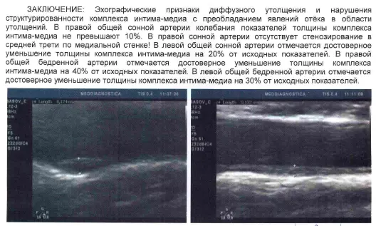 Атеросклероз судин головного мозку: діагностика та нехірургічне лікування в Києві