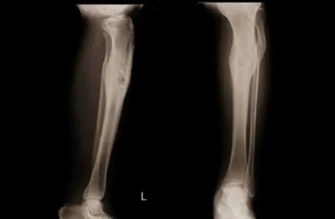 Біль в коліні. Лікування болю в коліні в Києві