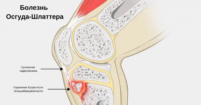 Біль в коліні. Лікування болю в коліні в Києві