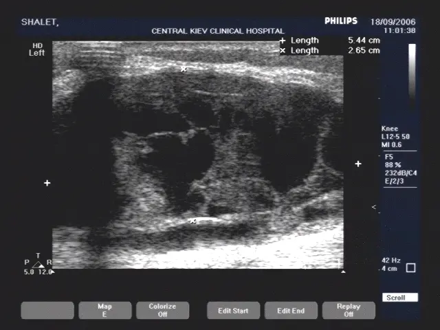 Проліферація синовіальної оболонки коліна при кісті Бейкера