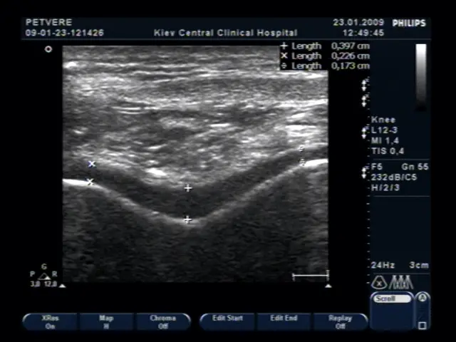Оцінка стану суглобового хряща коліна