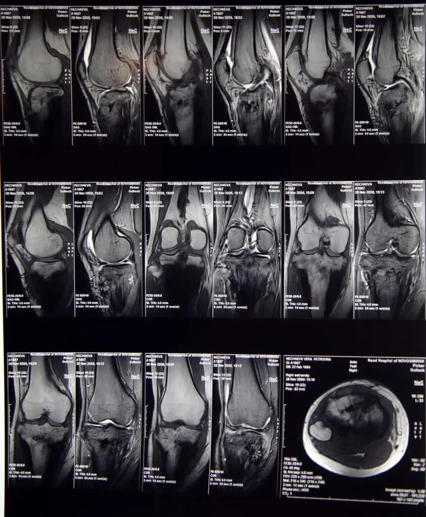 Біль в коліні. Лікування болю в коліні в Києві