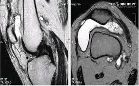 болить в колінному суглобі