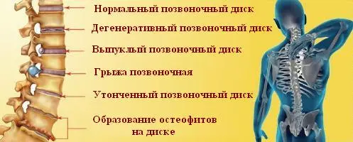 Боли в поясничной области Болі в поясниці