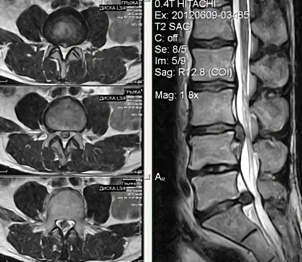 Шийний відділ хребта, протрузії міжхребцевих дисків